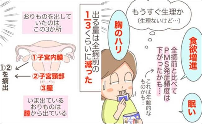 子宮を全摘したらどんな感じ？
