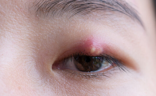 霰粒腫のイメージ